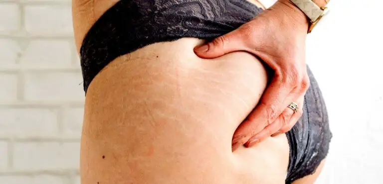 best products to remove stretch marks - close up photo of stria