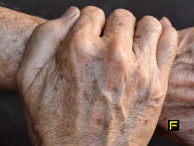 Age spots on hands.