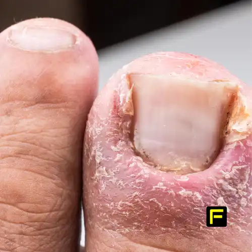 Does Bleach Kill Toenail Fungus? The Truth About This Popular Home Remedy 2 Does Bleach Kill Toenail Fungus? Photos