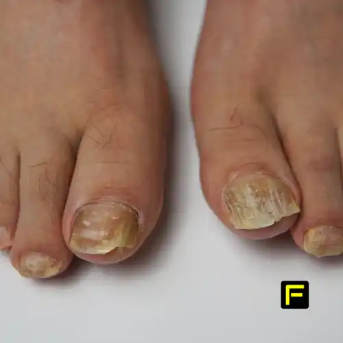 Understanding Undecylenic Acid for Toenail Fungus 1 Understanding Undecylenic Acid for Toenail Fungus