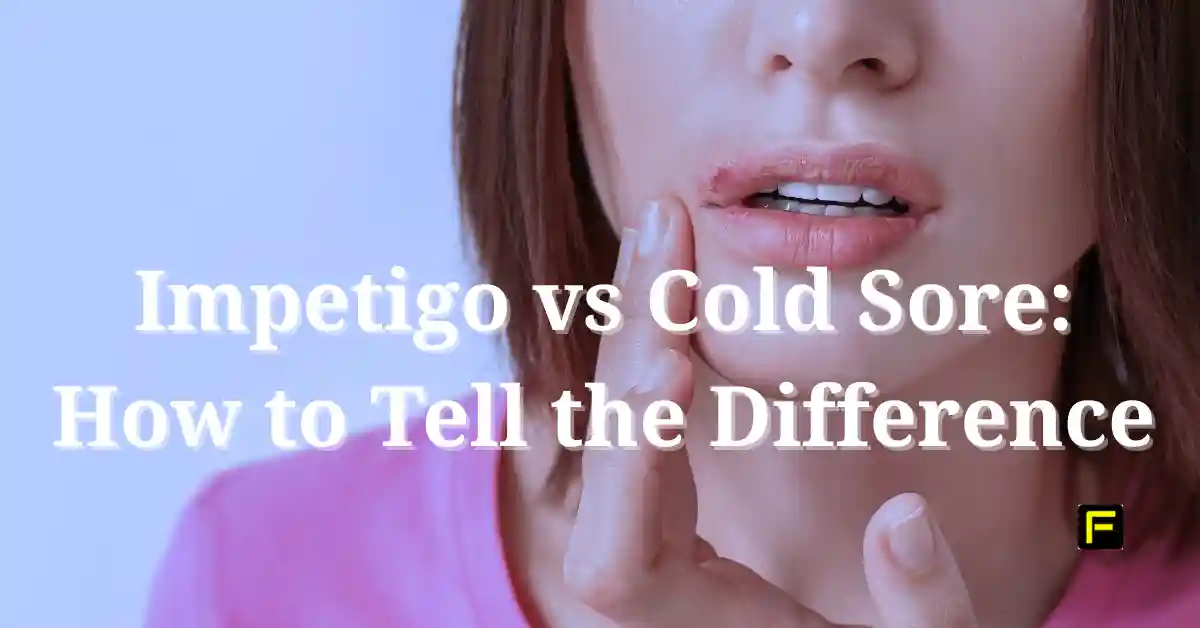 Impetigo vs Cold Sore. Featured image.