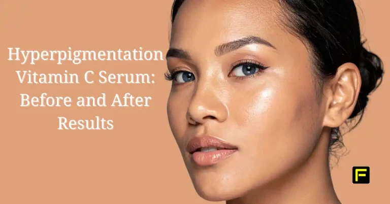 Hyperpigmentation Vitamin C Serum Before and After Results. Featured image.