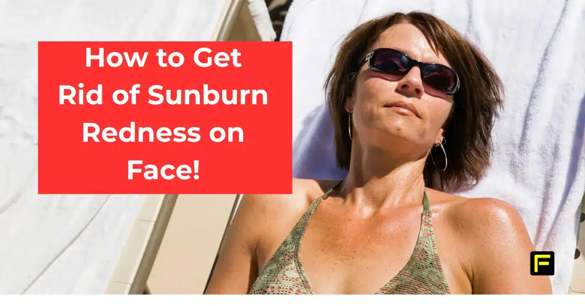 How to get rid of sunburn redness on face. Featured image.